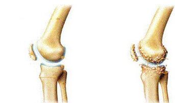 Knee -based atrocyse symptoms