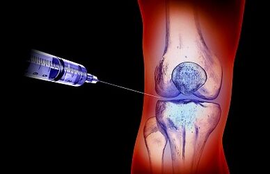 The treatment plan for osteoarthritis of the knee joint