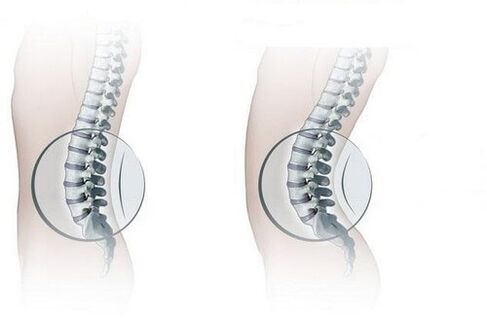 Normal spine and increased lumbar lordosis