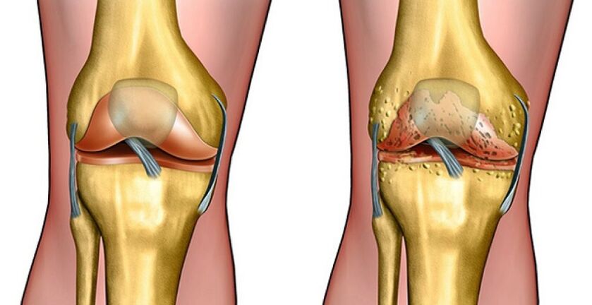 healthy joint and osteoarthritis of the knee joint
